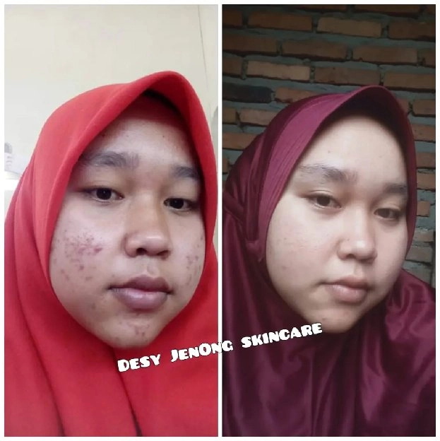 skincare maxie anti flek, jerawat, kusam