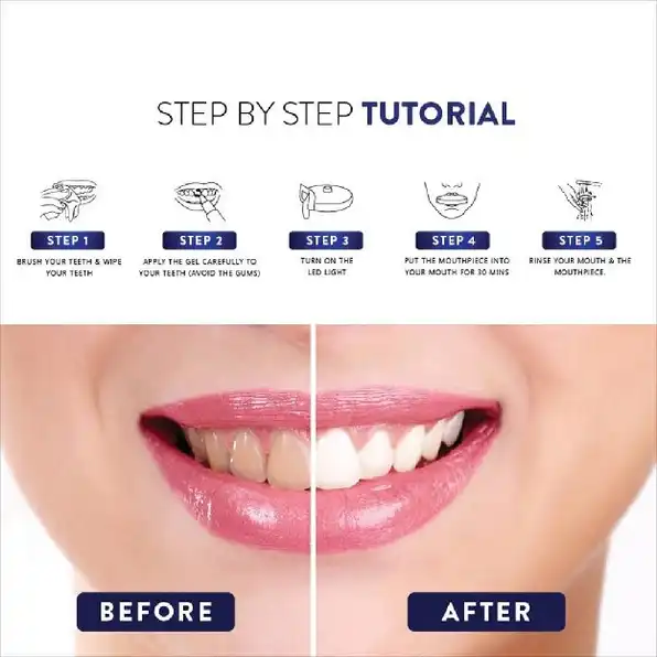 PRO TEETH WHITENING KIT Alat Pemutih Gigi Permanen | Beaudelab Memutihkan Gigi Super Cepat NewLab Ne