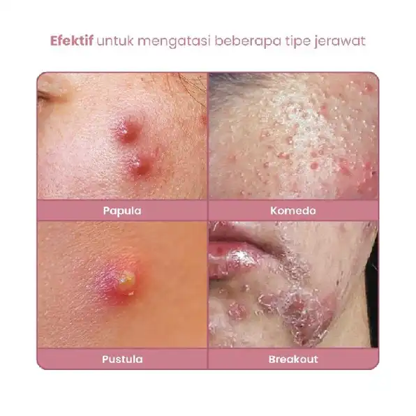 BUVON Pink Acne Shot Obat Totol Jerawat 30ml