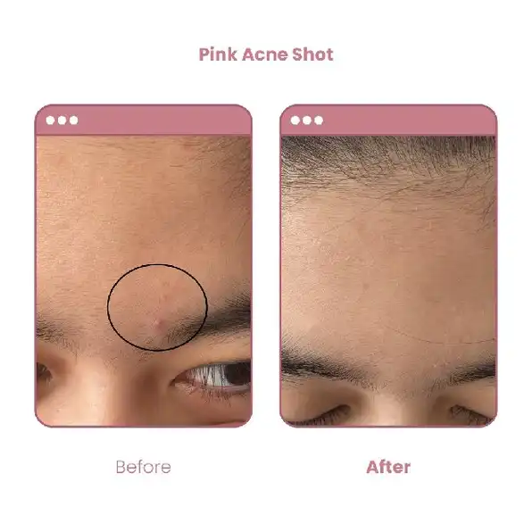 BUVON Pink Acne Shot Obat Totol Jerawat 30ml