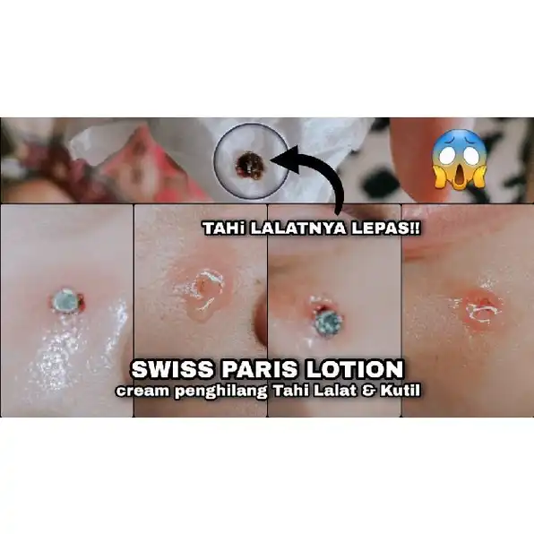 ????? ????? LOTION / Penghilang Tahi Lalat, Kutil, Mata Ikan, Dan Keloid