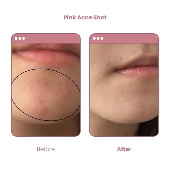 BUVON Pink Acne Shot Obat Totol Jerawat 30ml