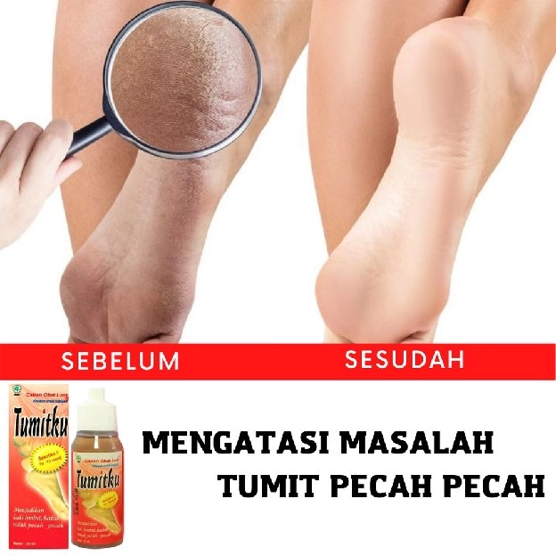 Tumitku Obat Kaki Pecah Original Bpom Tumit Pecah dan Kering Tumitku Mengatasi Kaki Pecah Pecah Dan 