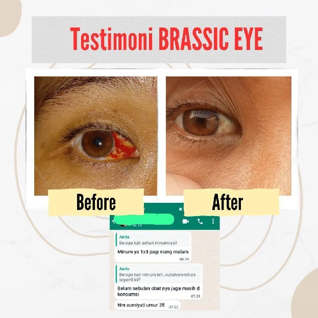 BRASSIC EYE