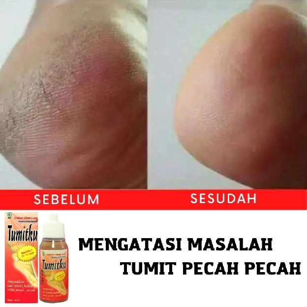 Tumitku Obat Kaki Pecah Original Bpom Tumit Pecah dan Kering Tumitku Mengatasi Kaki Pecah Pecah Dan 