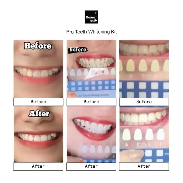 PRO TEETH WHITENING KIT Alat Pemutih Gigi Permanen | Beaudelab Memutihkan Gigi Super Cepat NewLab Ne