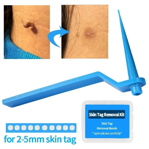 Skin Tag Removal Kit Skin Tag Remover Wart Remover Obat Kutil Penghilang Wart Removal Kit High Quali