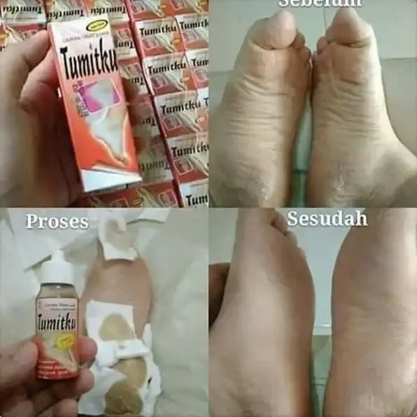 TUMITKU Obat Kaki Pecah 100% Original BPOM Solusi Kaki Pecah-pecah Kapalan Kering Ampuh