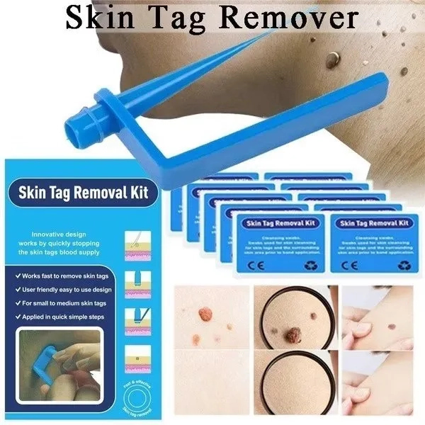 Skin Tag Removal Kit Skin Tag Remover Wart Remover Obat Kutil Penghilang Wart Removal Kit High Quali