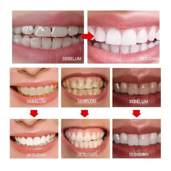 Pemutih Gigi Serbuk Snap On Smile Teeth Whitening BREYLE Powder Mint Pemutih Gigi Kuning Permanen Am