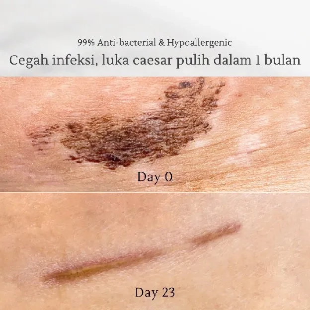 Mamaway / FAST SLIM Antibakteri & Aman untuk Caesar / Korset Pelangsing Pasca Melahirkan Nano Bamboo