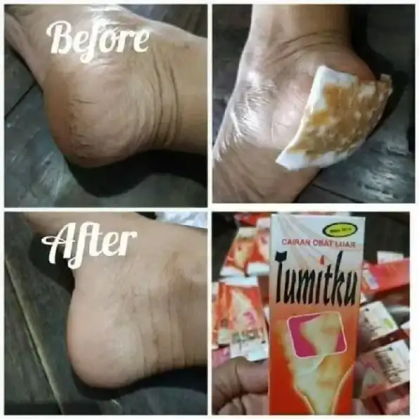 𝗕𝗣𝗢𝗠 TUMITKU Obat Kaki Pecah Pecah 100% Original Solusi Kaki Kapalan Kering Kalus