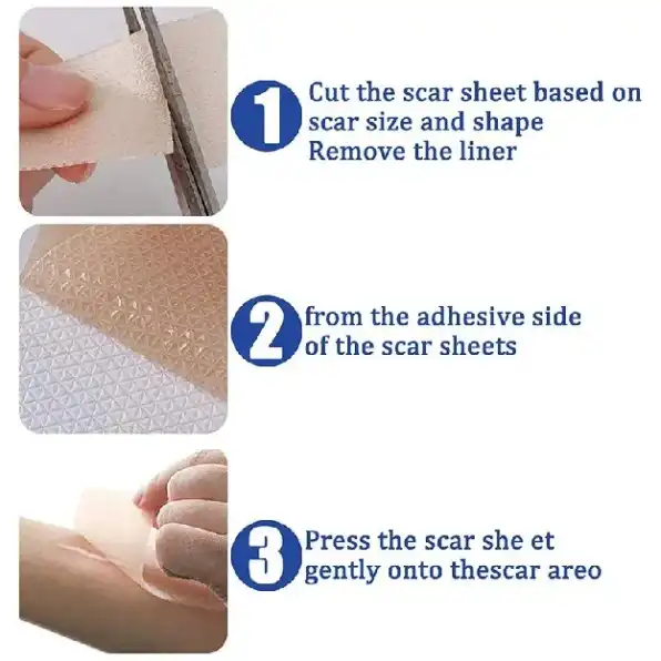 Silicone Scar Sheet lester silikon penghilang keloid bekas luka