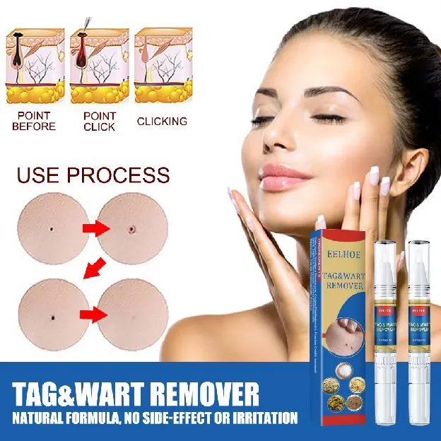 Penghilang Tahi Lalat Penghilang Kutil Skin Tag Remover Obat kutil di leher Penghilang kutil wajah