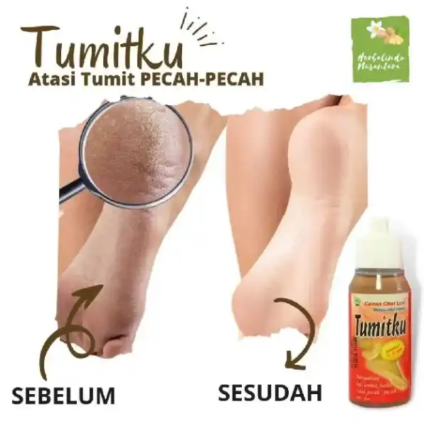 𝗕𝗣𝗢𝗠 TUMITKU Obat Kaki Pecah Pecah 100% Original Solusi Kaki Kapalan Kering Kalus