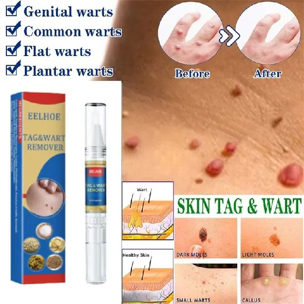 Penghilang Tahi Lalat Penghilang Kutil Skin Tag Remover Obat kutil di leher Penghilang kutil wajah