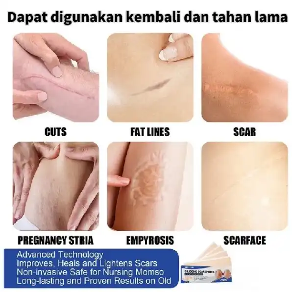 Silicone Scar Sheet lester silikon penghilang keloid bekas luka