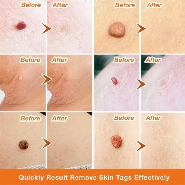 Penghilang Tahi Lalat Penghilang Kutil Skin Tag Remover Obat kutil di leher Penghilang kutil wajah