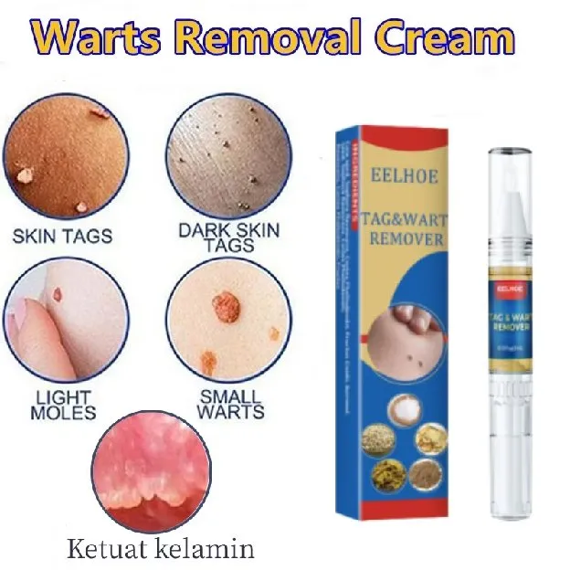 Penghilang Tahi Lalat Penghilang Kutil Skin Tag Remover Obat kutil di leher Penghilang kutil wajah