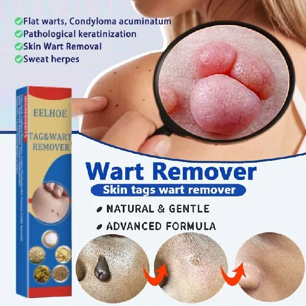 Penghilang Tahi Lalat Penghilang Kutil Skin Tag Remover Obat kutil di leher Penghilang kutil wajah